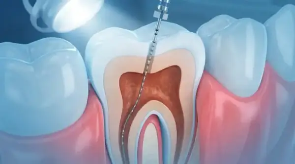 Tratamento de canal (endodontia) na Dentemergência