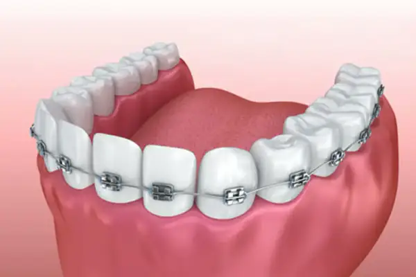 Reabilitação com prótese dentária na Dentemergência